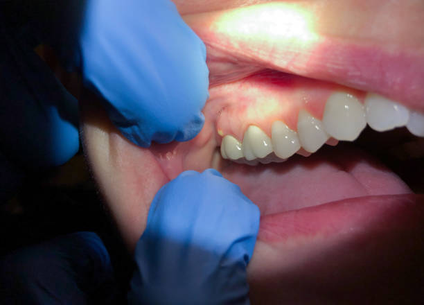 Best Emergency Denture Repair in Silverton, OH