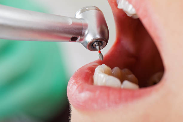 Best Emergency Wisdom Tooth Extraction in Silverton, OH